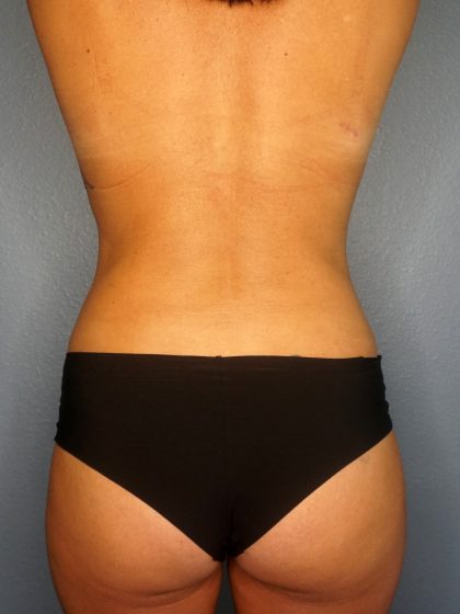 Breast Augmentation Before & After Patient #1657