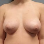 Breast Augmentation Before & After Patient #1524