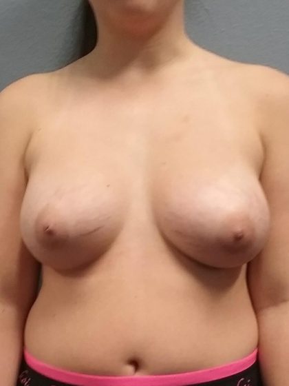 Breast Augmentation Before & After Patient #1524