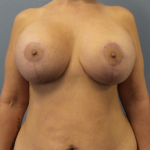 Mastopexy (Breast Lift) Before & After Patient #828