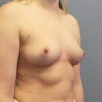Breast Augmentation Before & After Patient #1611