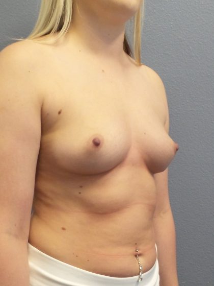 Breast Augmentation Before & After Patient #1611
