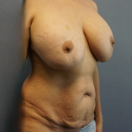 Mommy Makeover Before & After Patient #1911