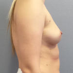 Breast Augmentation Before & After Patient #1611