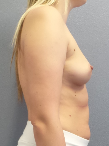 Breast Augmentation Before & After Patient #1611