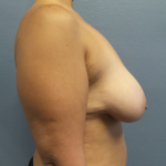 Mastopexy (Breast Lift) Before & After Patient #828