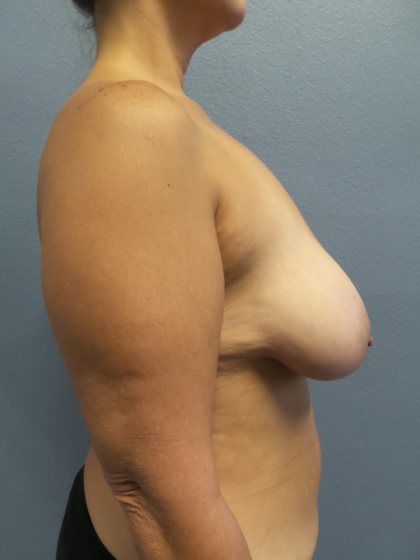 Mastopexy (Breast Lift) Before & After Patient #828