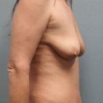 Mommy Makeover Before & After Patient #1964