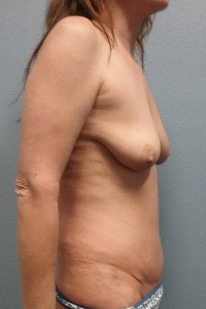 Mommy Makeover Before & After Patient #1964