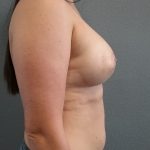 Breast Augmentation Before & After Patient #1549