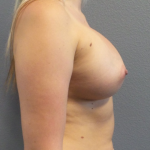 Breast Augmentation Before & After Patient #1611