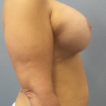 Mastopexy (Breast Lift) Before & After Patient #828