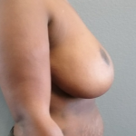Breast Reduction Before & After Patient #1831