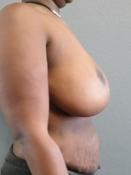 Breast Reduction Before & After Patient #1831