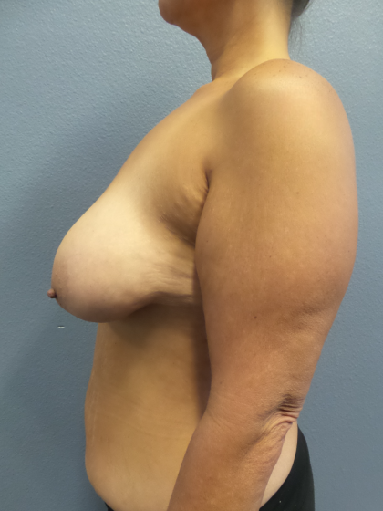 Mastopexy (Breast Lift) Before & After Patient #828