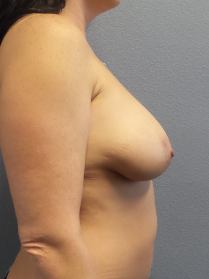 Mastopexy (Breast Lift) Before & After Patient #717