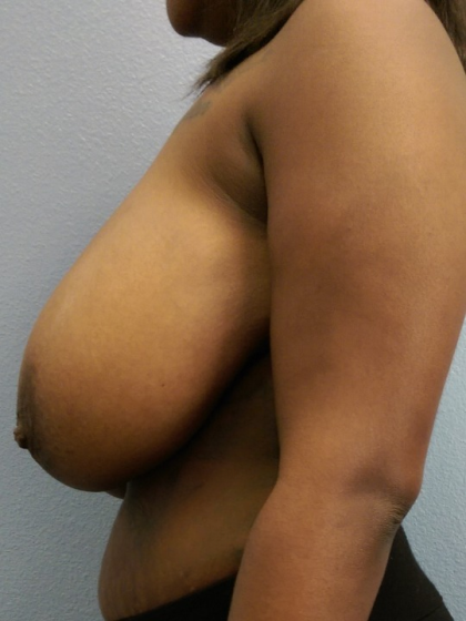 Breast Reduction Before & After Patient #1831
