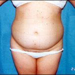 Liposuction Female Before & After Patient #2412