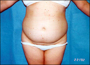 Liposuction Female Before & After Patient #2412