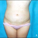 Liposuction Female Before & After Patient #2412