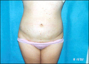 Liposuction Female Before & After Patient #2412