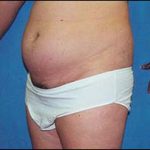 Liposuction Female Before & After Patient #2413