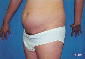 Liposuction Female Before & After Patient #2413