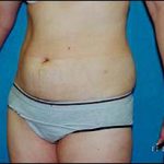 Liposuction Female Before & After Patient #2413