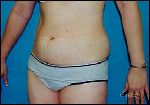Liposuction Female Before & After Patient #2413