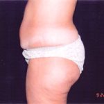 Liposuction Female Before & After Patient #2411