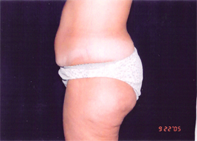 Liposuction Female Before & After Patient #2411