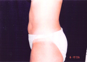 Liposuction Female Before & After Patient #2411