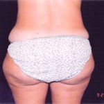 Liposuction Female Before & After Patient #2411