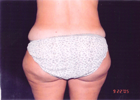 Liposuction Female Before & After Patient #2411