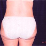 Liposuction Female Before & After Patient #2411