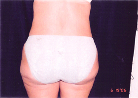 Liposuction Female Before & After Patient #2411