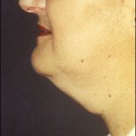 Neck Lift Before & After Patient #2451