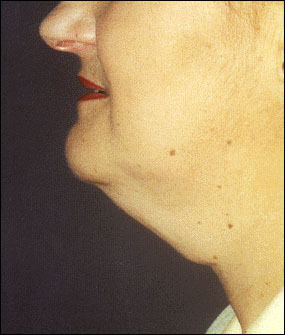 Neck Lift Before & After Patient #2451