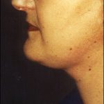 Neck Lift Before & After Patient #2451