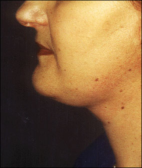 Neck Lift Before & After Patient #2451