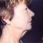 Neck Lift Before & After Patient #2452