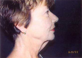 Neck Lift Before & After Patient #2452