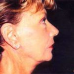 Neck Lift Before & After Patient #2452