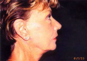 Neck Lift Before & After Patient #2452