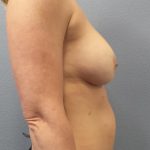 Breast Augmentation Revision (Breast Enlargement Repair) Before & After Patient #663