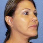 Facelift Before & After Patient #921