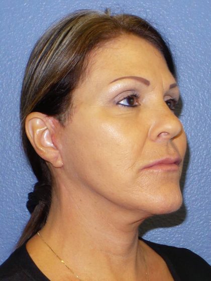 Facelift Before & After Patient #921