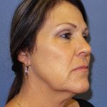 Facelift Before & After Patient #921
