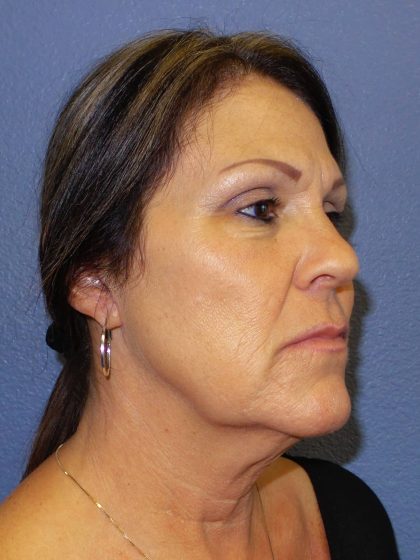 Facelift Before & After Patient #921