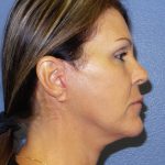 Facelift Before & After Patient #921